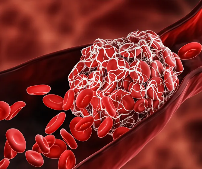 Fiona McBryde | Ischemic Stroke Blood Pressure Research